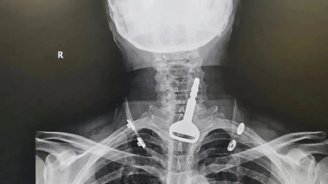 Саудия Арабистонида эркакнинг томоғига машина калити тиқилиб қолди